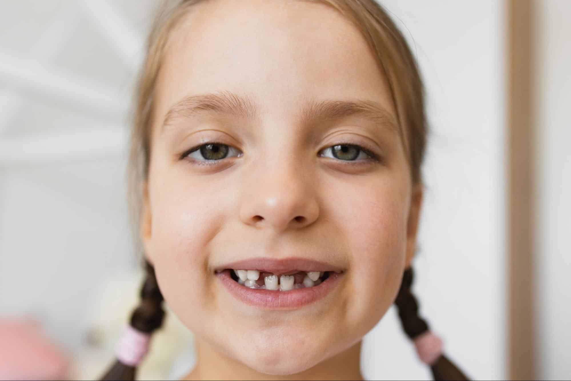 agenesia dental