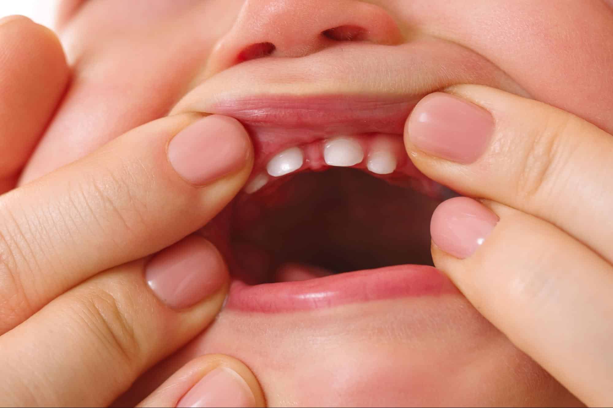 frenillo labial inferior