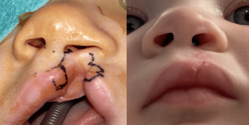 labio leporino bilateral