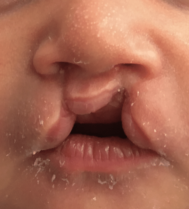 labio leporino unilateral
