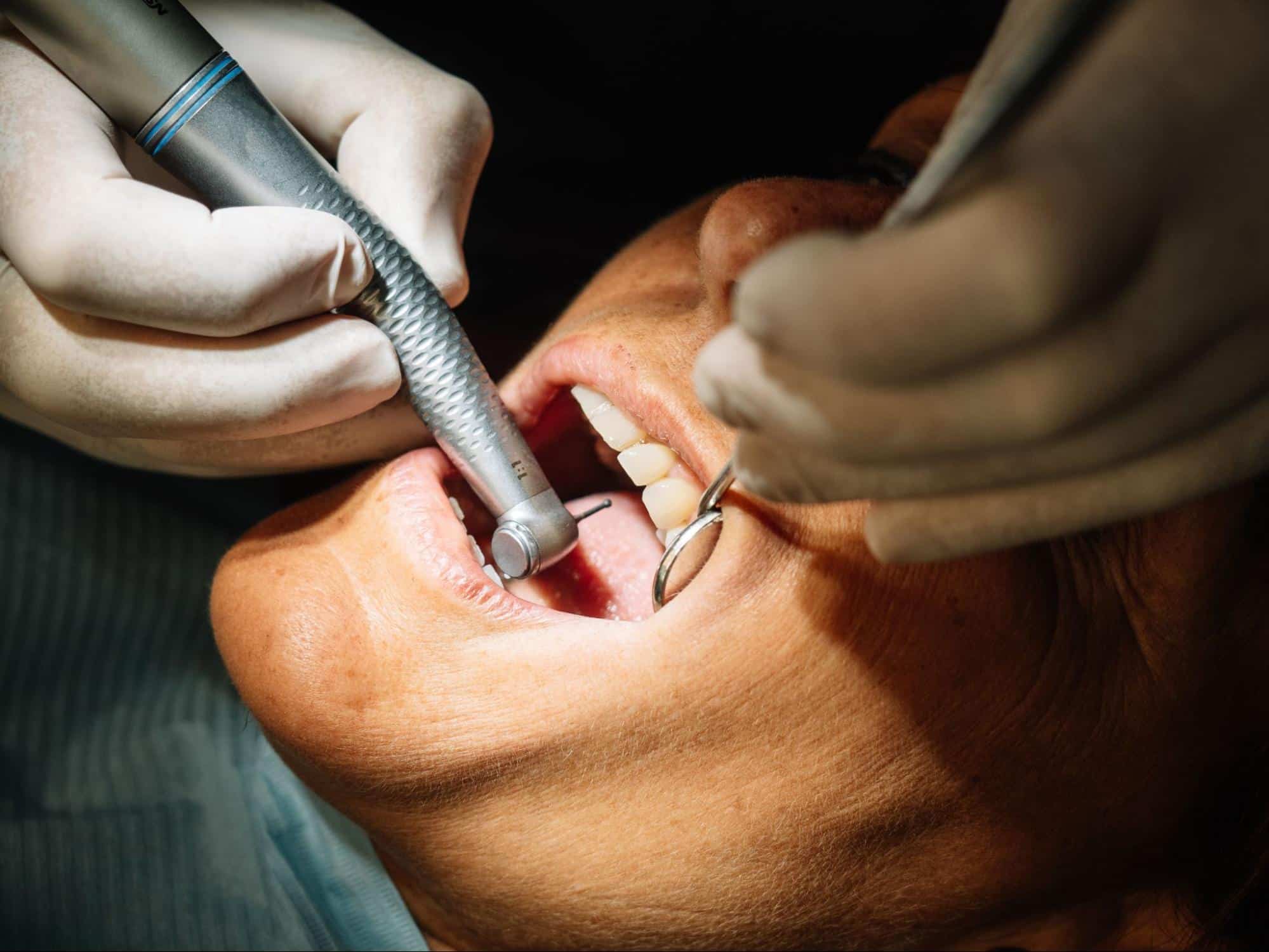 que es una caries dental