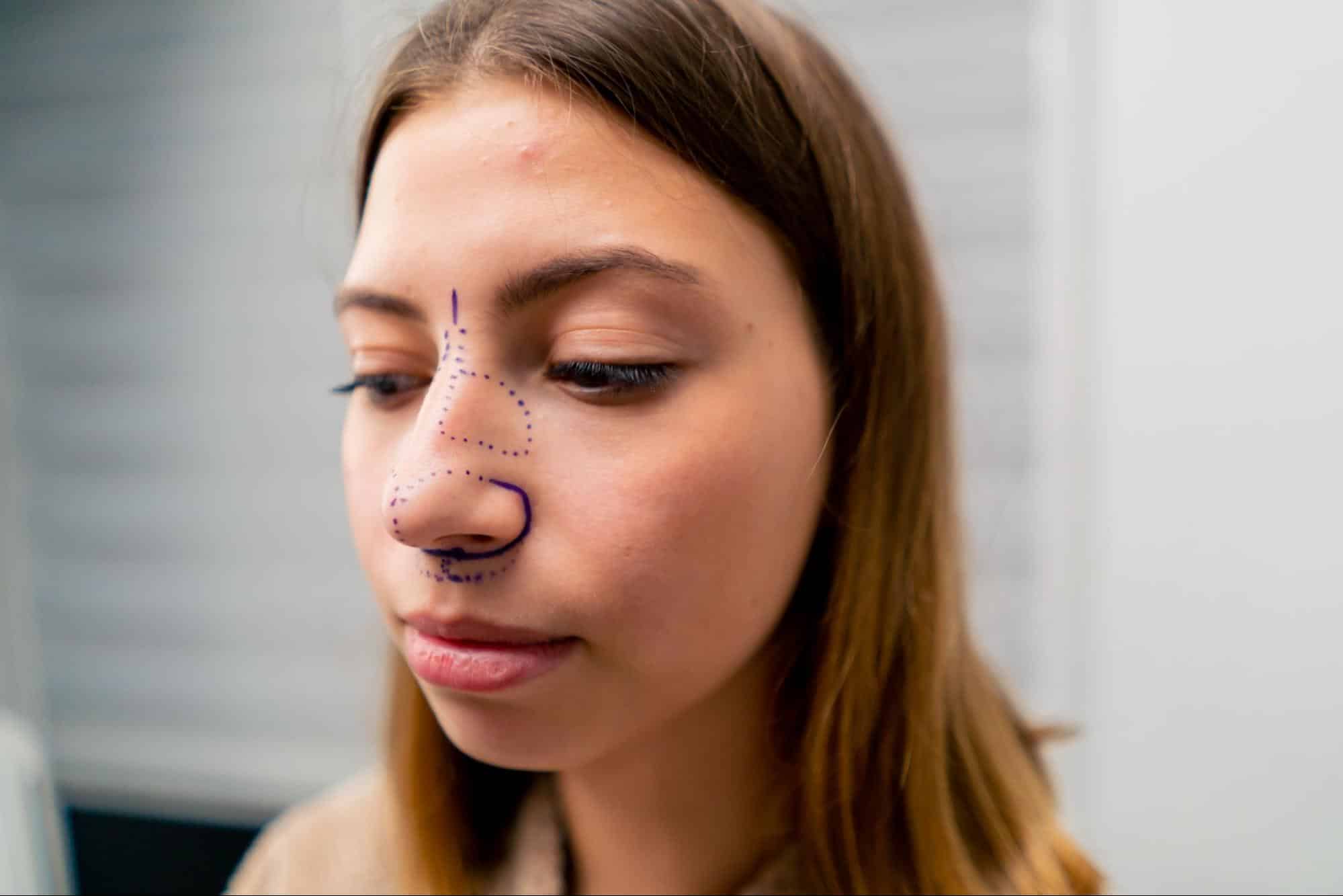 tabique nasal desviado sintomas