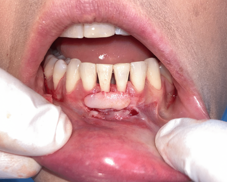 como se mide la recesion gingival