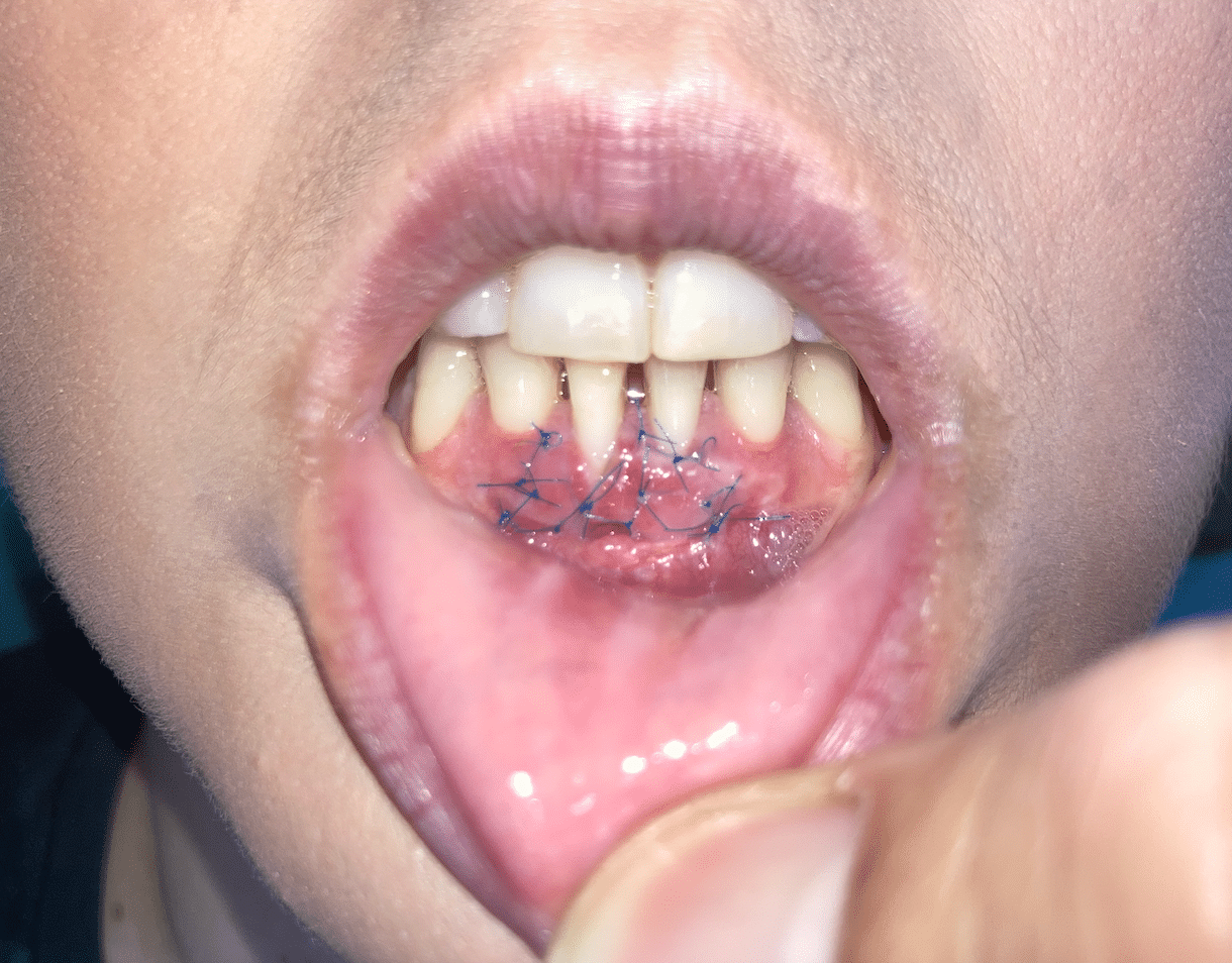 dientes con recesion gingival