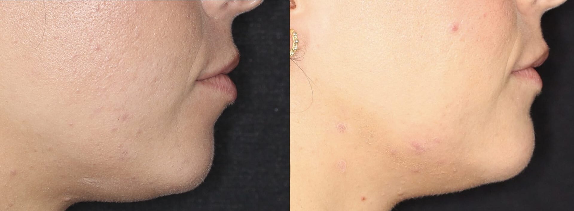 como corregir el menton retraido