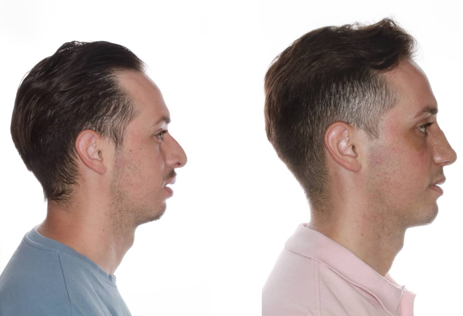 como corregir el menton retraido