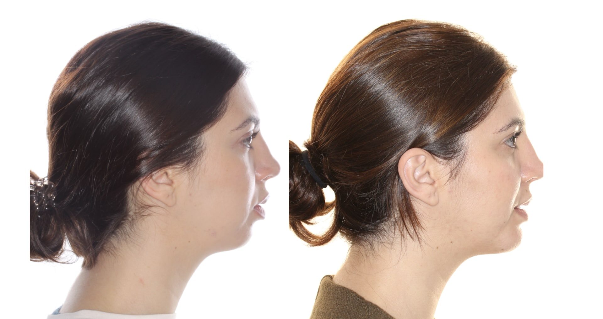 tipos de menton retraido