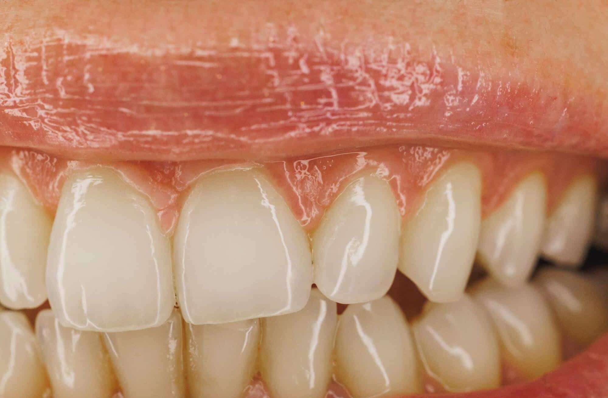 enfermedad periodontal