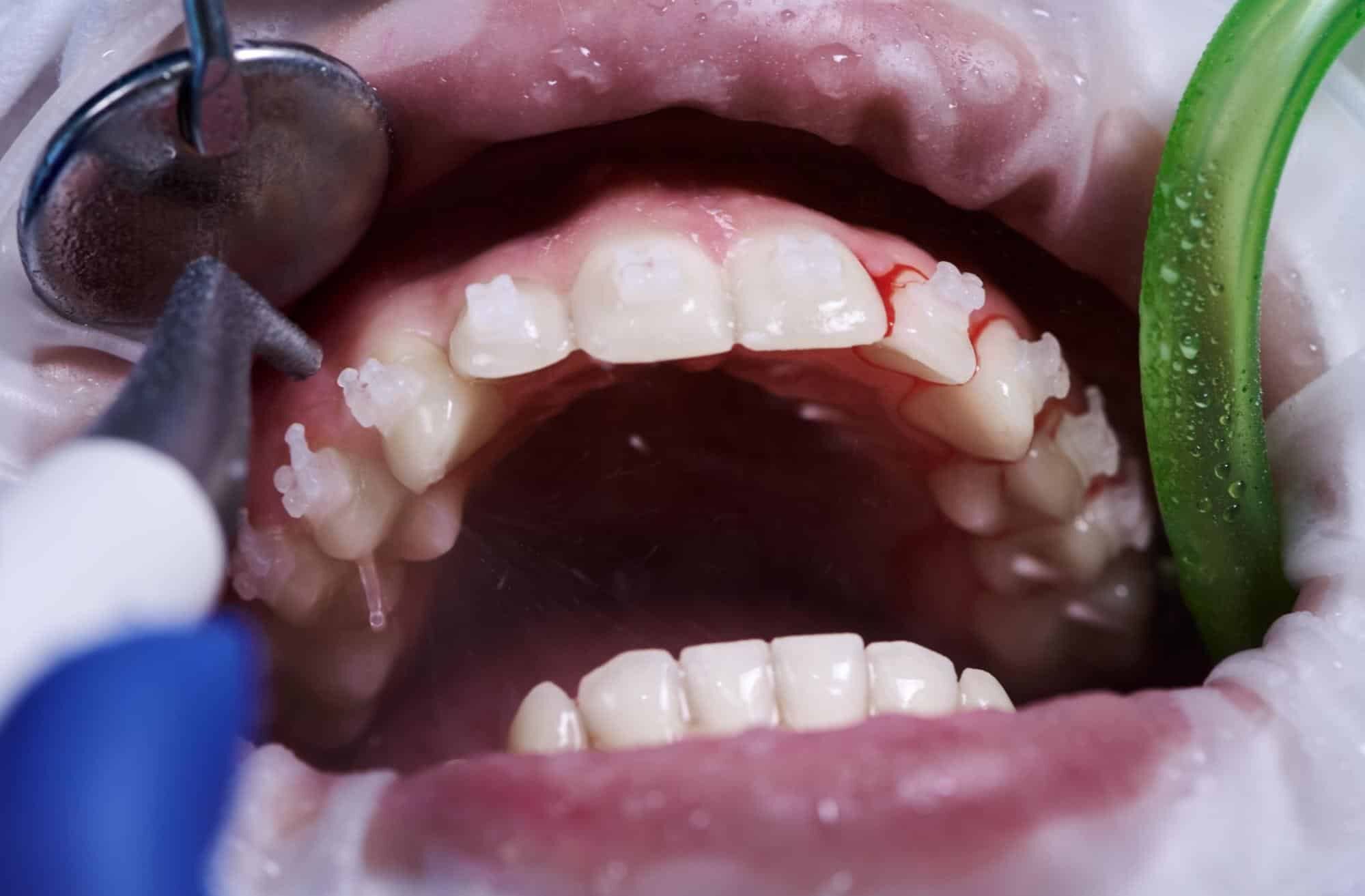 enfermedad periodontal tratamiento