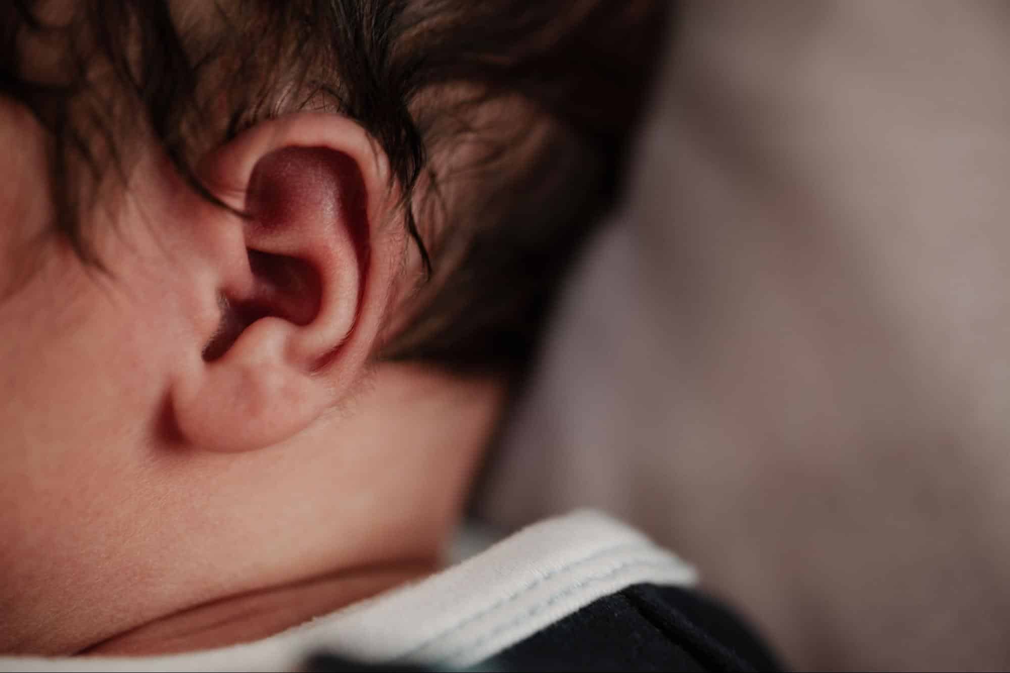 apendice preauricular recien nacidos