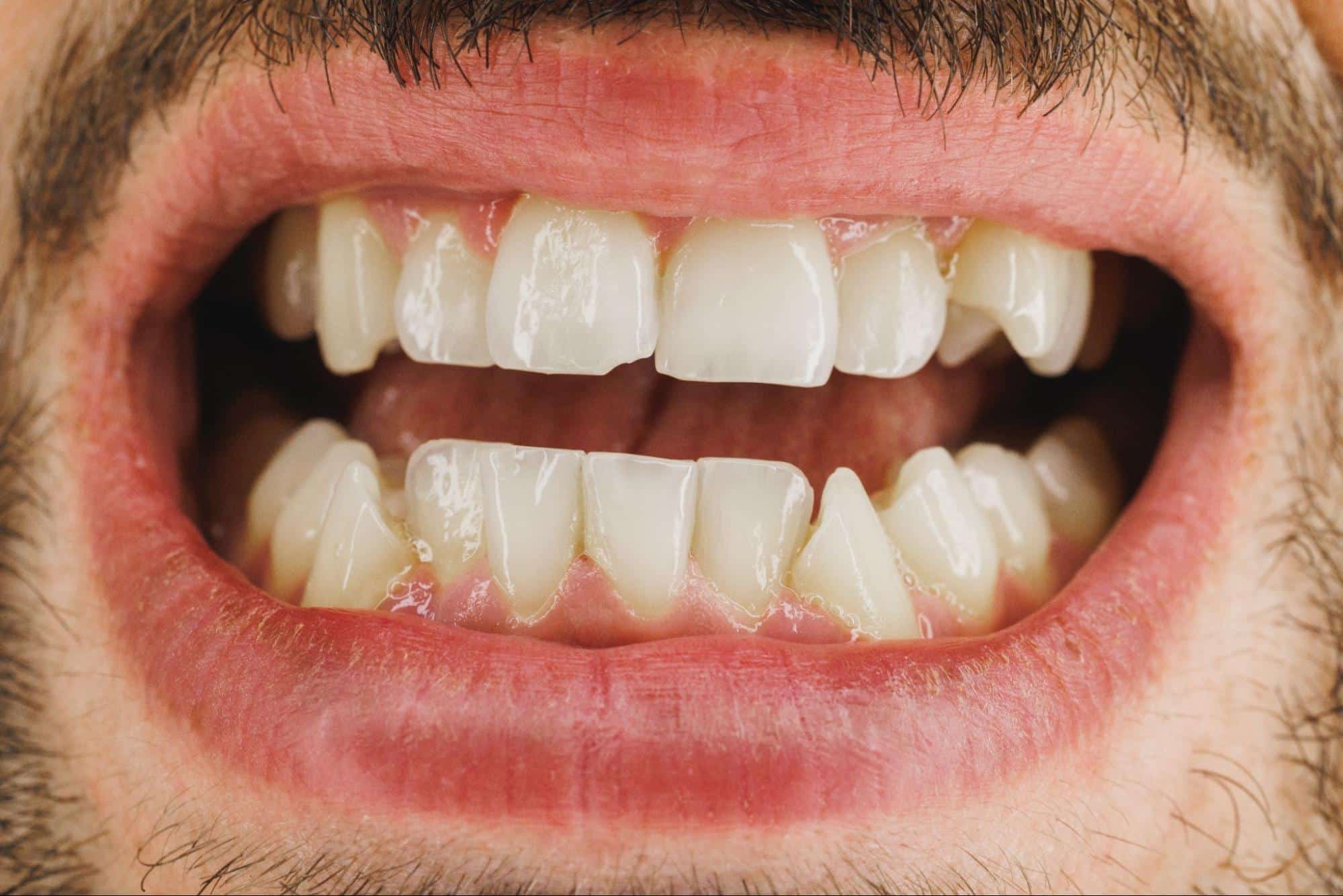 maloclusion dental