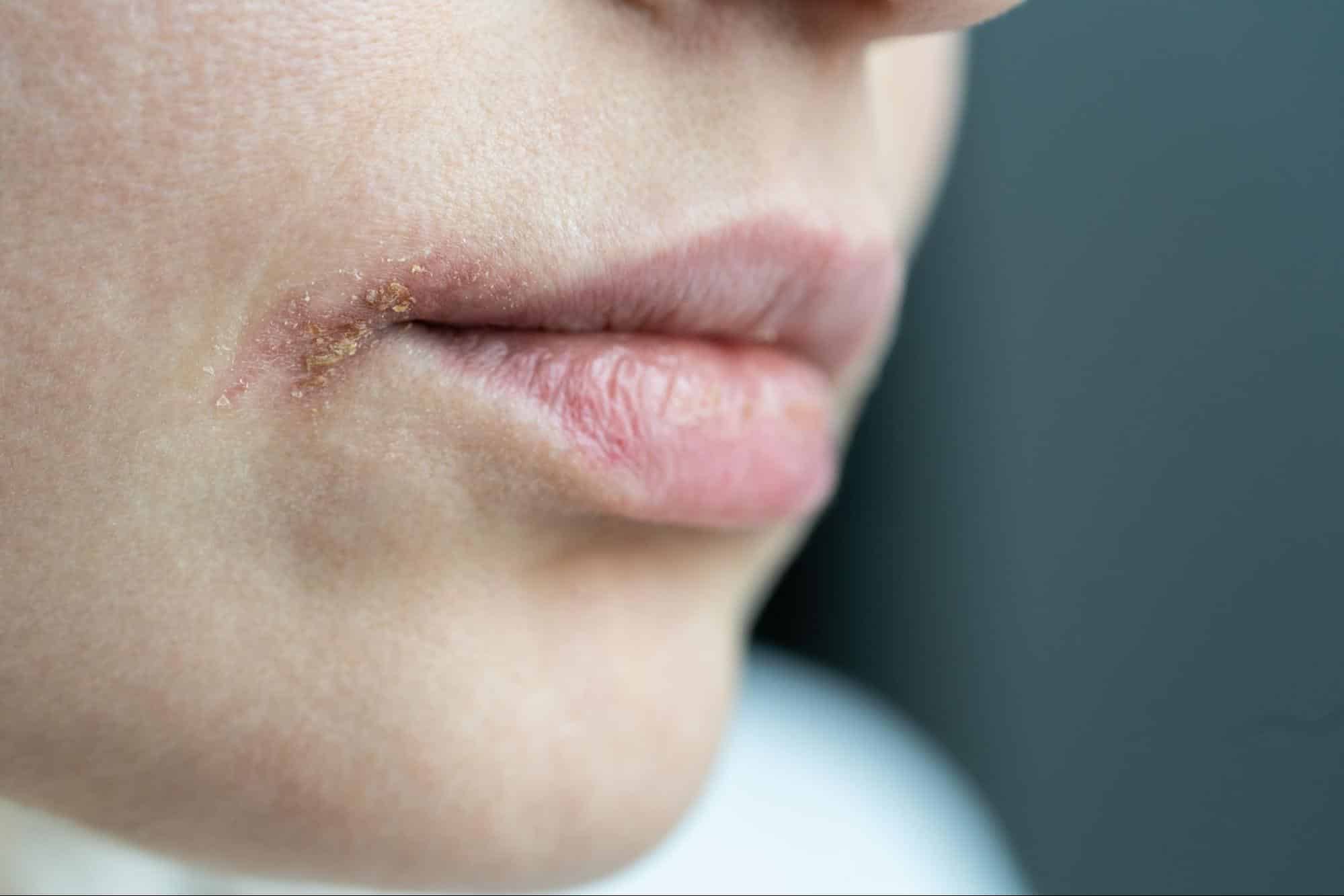 boqueras queilitis angular