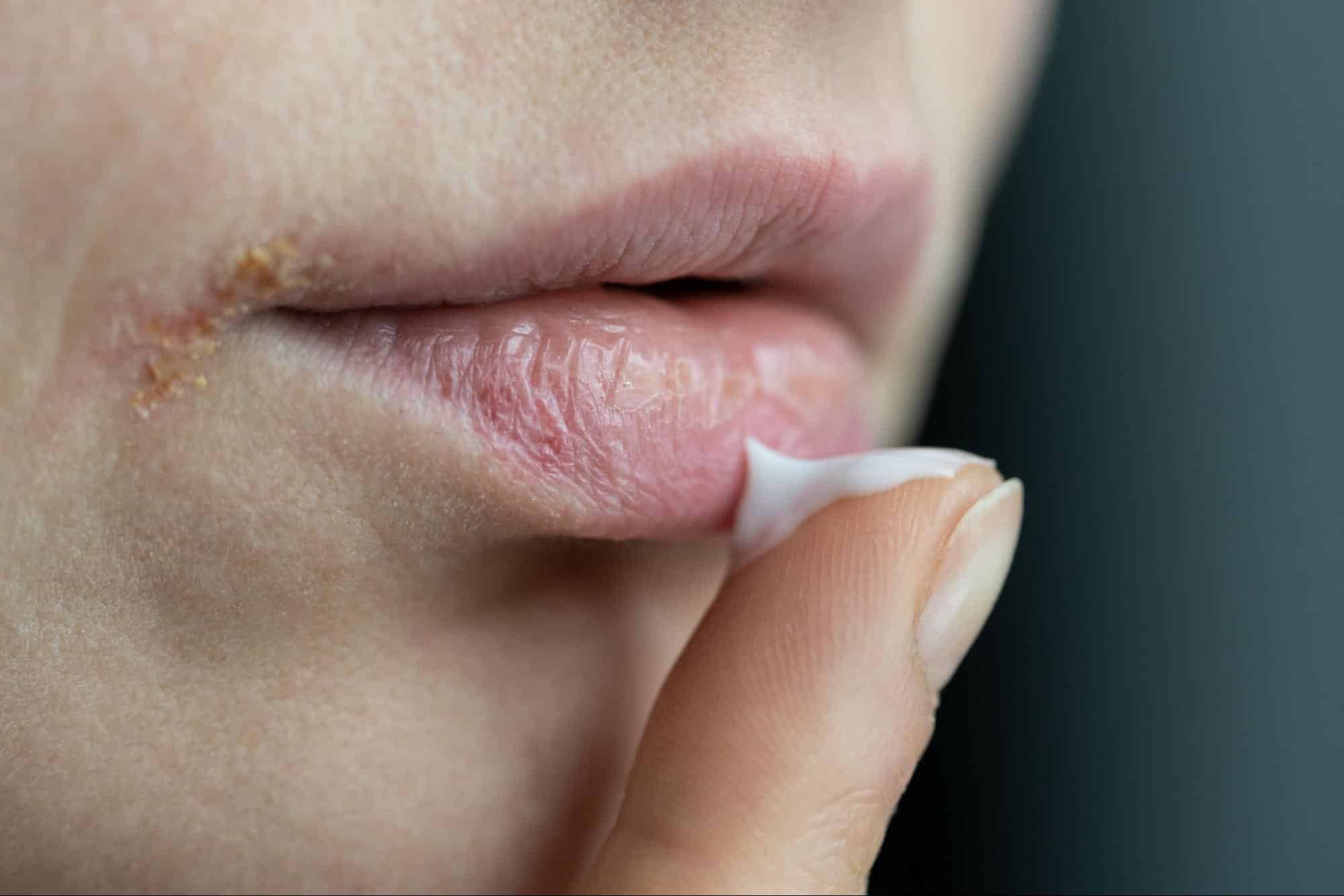 queilitis angular